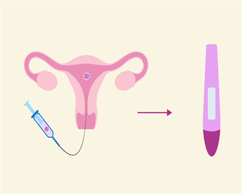 试管婴儿冻胚移植34天，子宫后位对胚胎着床的影响分析